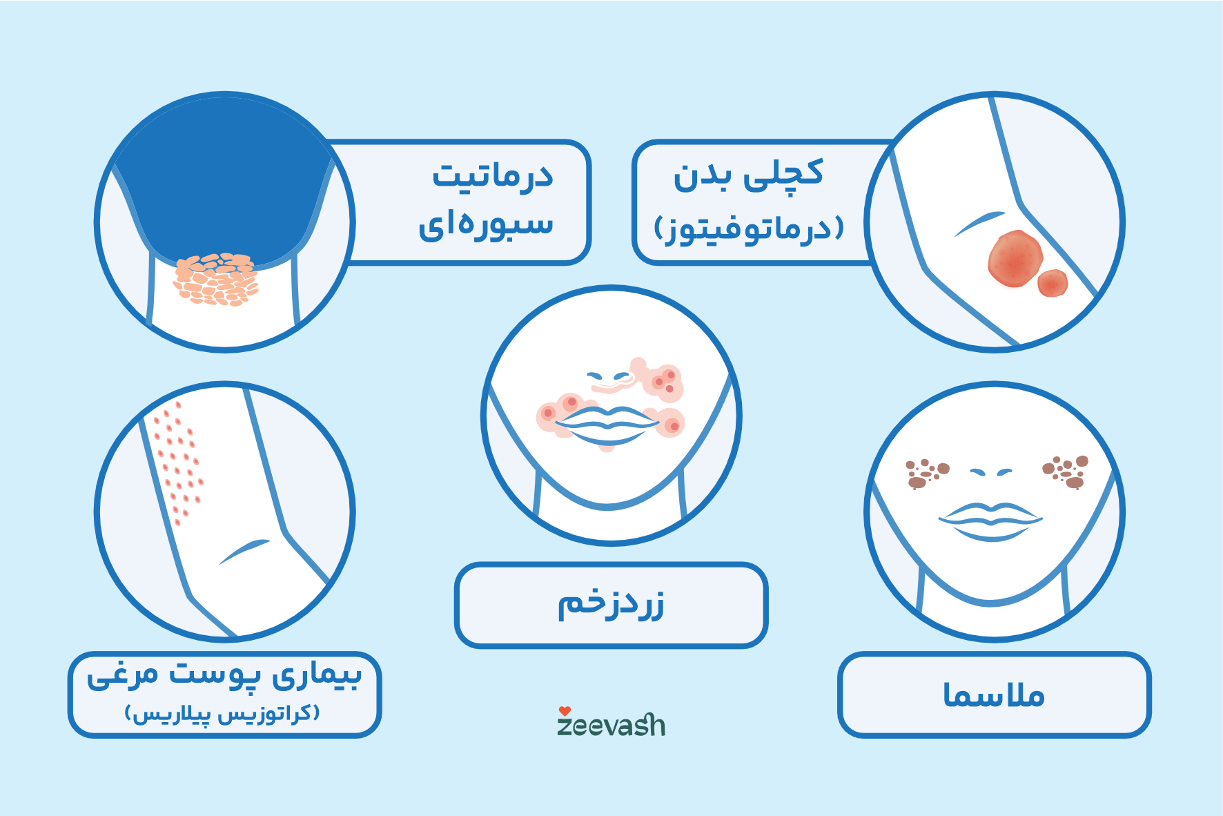 عکس بیماری های پوستی - ملاسما زردزخم کچلی بدن پوست مرغی
